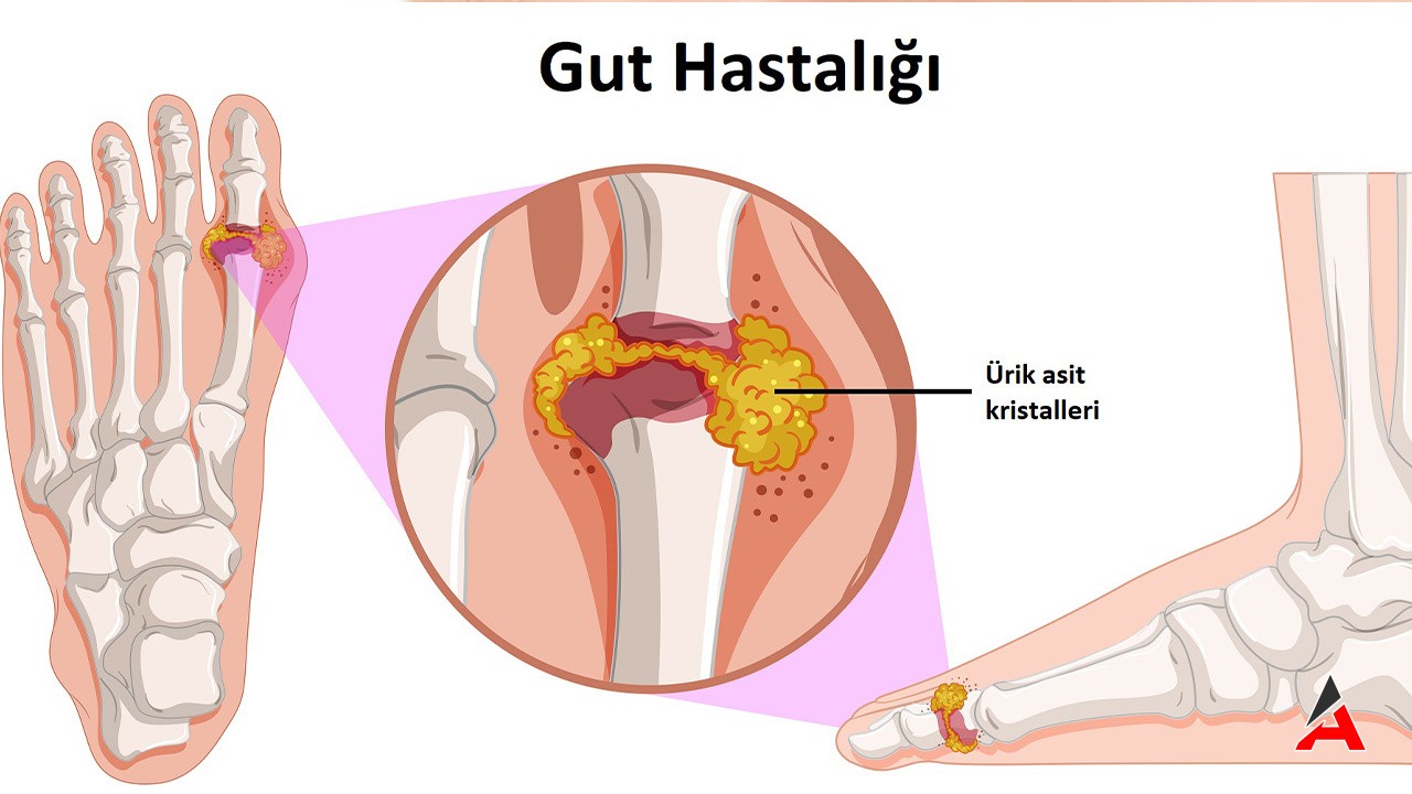 Gut Hastalığı