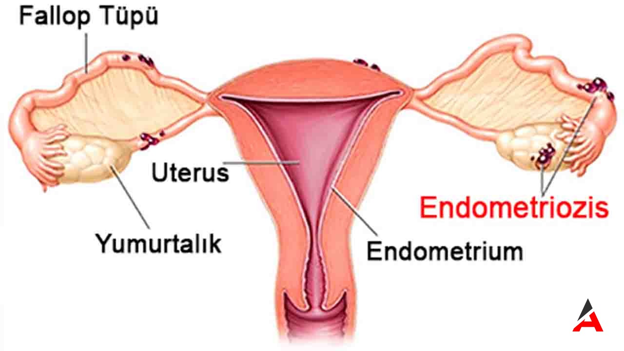 Endometriozis, Çikolata Kisti Belirtileri